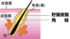 毛穴の中の皮脂腺から分泌した皮脂がたまってできた貯留皮脂と、そこに角質が混じり合ってできた固形状の角栓のイメージイラスト